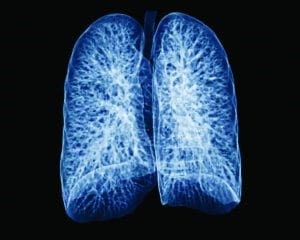 Lung Spectrum Xray