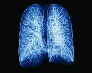 Lung Spectrum Xray